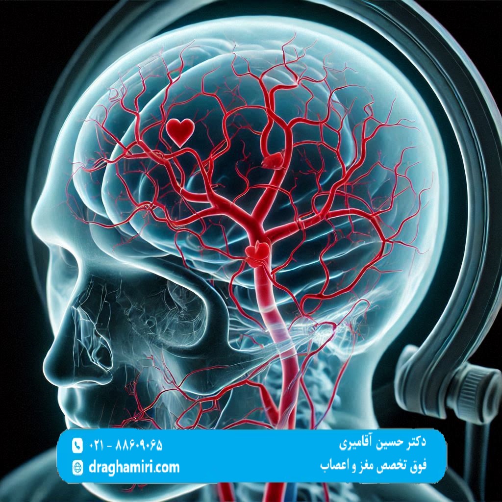 سکته مغزی